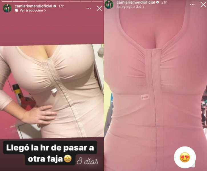 Resultados de la operación estética de Camila Arismendi