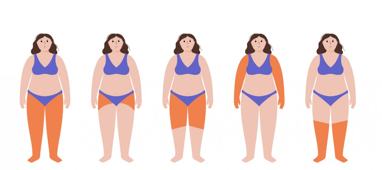 Lipedema: la enfermedad silenciosa que afecta a miles de mujeres y suele confundirse con obesidad