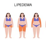 Lipedema: la enfermedad silenciosa que afecta a miles de mujeres y suele confundirse con obesidad